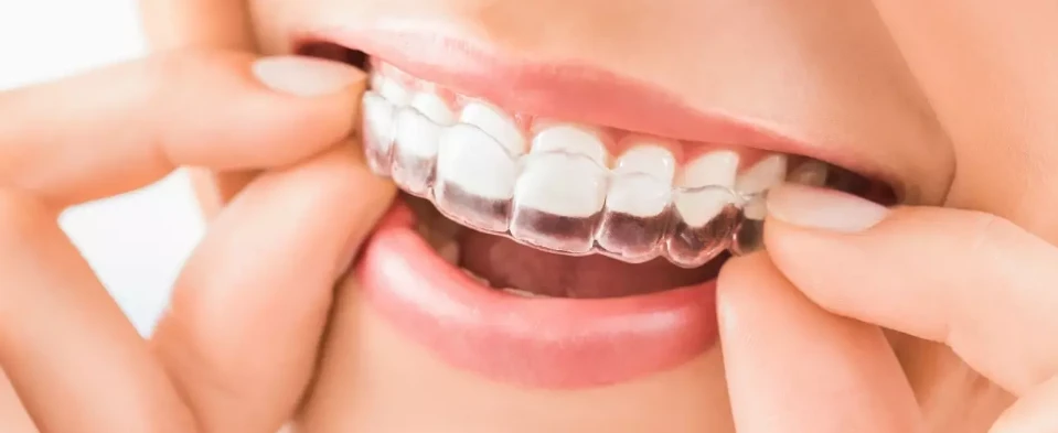 تقويم الأسنان الشفاف